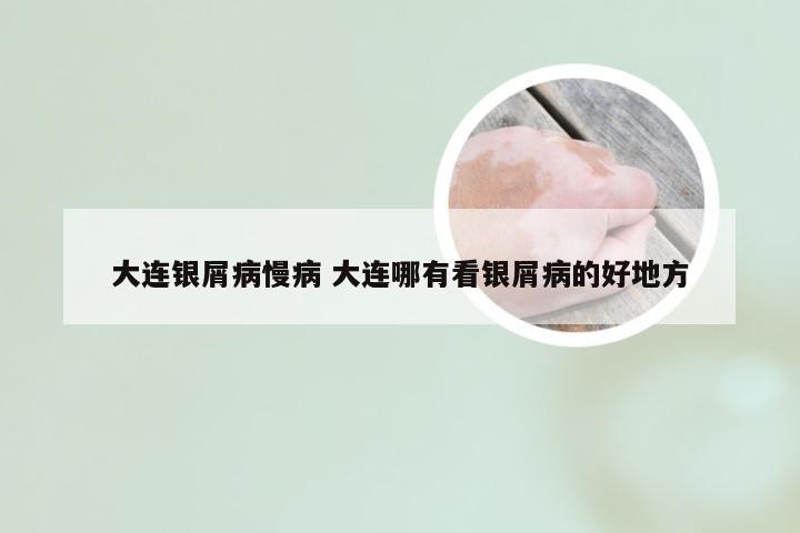 大连银屑病慢病 大连哪有看银屑病的好地方