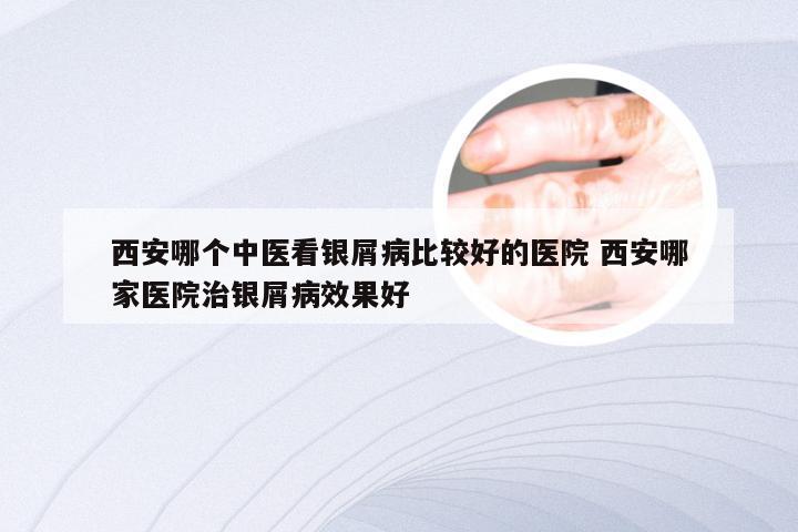 西安哪个中医看银屑病比较好的医院 西安哪家医院治银屑病效果好