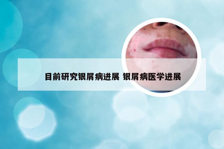 目前研究银屑病进展 银屑病医学进展