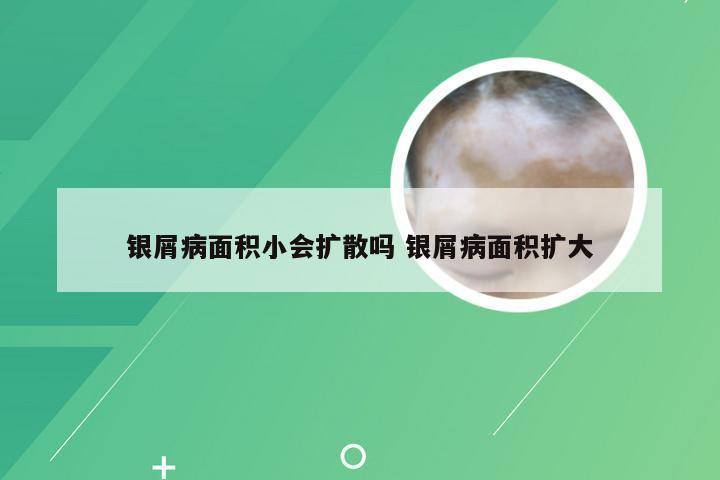 银屑病面积小会扩散吗 银屑病面积扩大