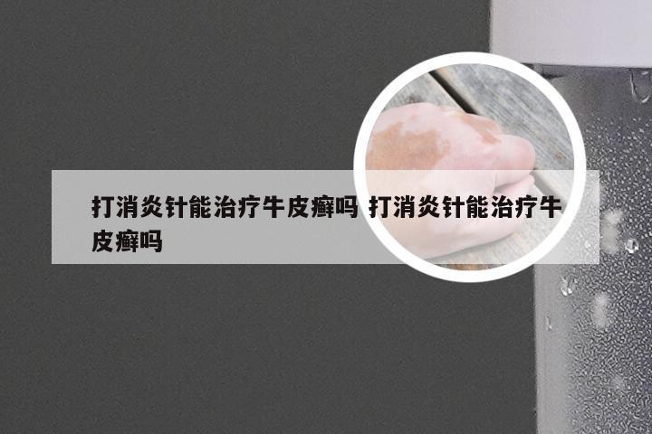 打消炎针能治疗牛皮癣吗 打消炎针能治疗牛皮癣吗
