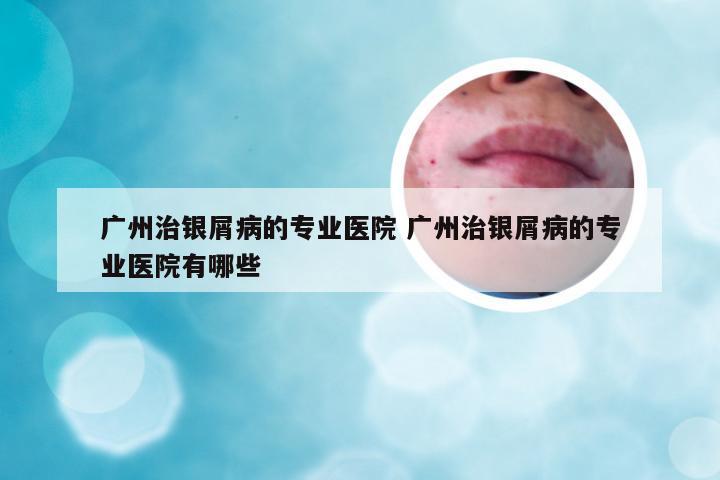 广州治银屑病的专业医院 广州治银屑病的专业医院有哪些