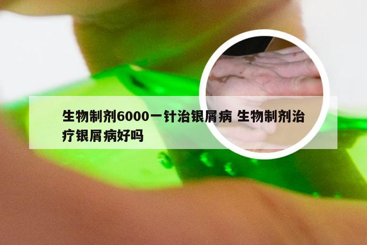 生物制剂6000一针治银屑病 生物制剂治疗银屑病好吗