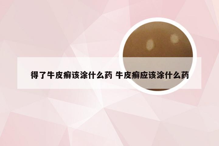 得了牛皮癣该涂什么药 牛皮癣应该涂什么药