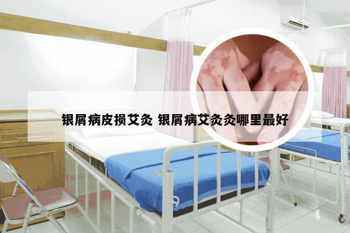 银屑病皮损艾灸 银屑病艾灸灸哪里最好