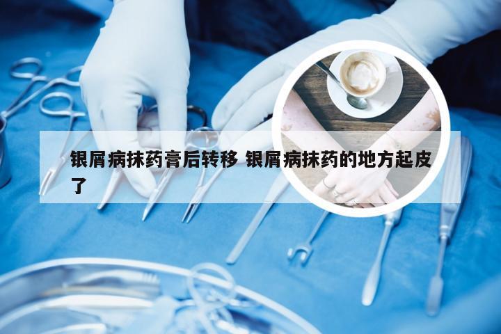 银屑病抹药膏后转移 银屑病抹药的地方起皮了