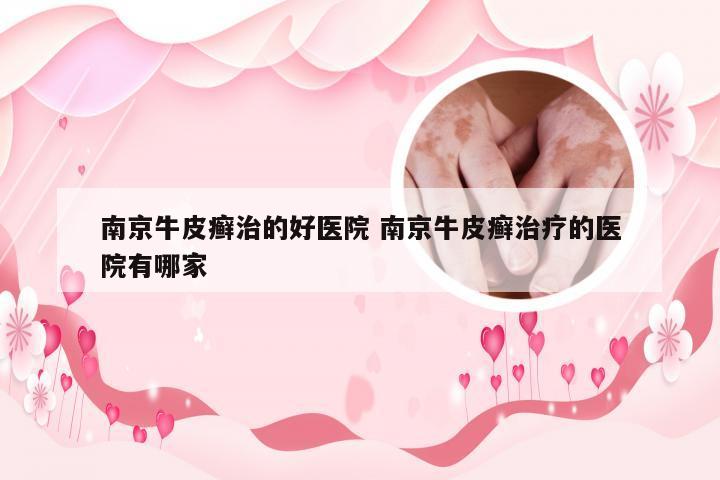 南京牛皮癣治的好医院 南京牛皮癣治疗的医院有哪家