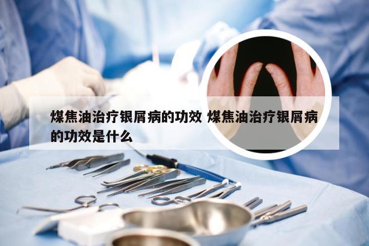 煤焦油治疗银屑病的功效 煤焦油治疗银屑病的功效是什么