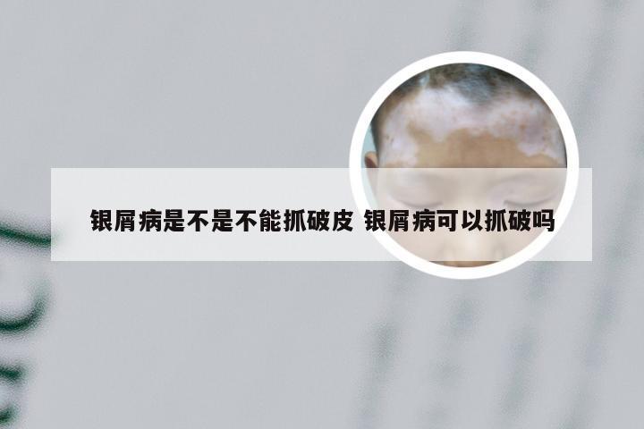 银屑病是不是不能抓破皮 银屑病可以抓破吗