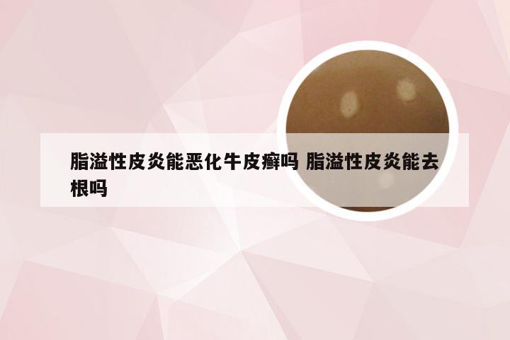 脂溢性皮炎能恶化牛皮癣吗 脂溢性皮炎能去根吗
