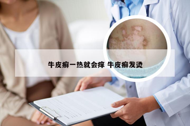 牛皮癣一热就会痒 牛皮癣发烫