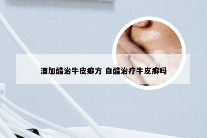 酒加醋治牛皮癣方 白醋治疗牛皮癣吗