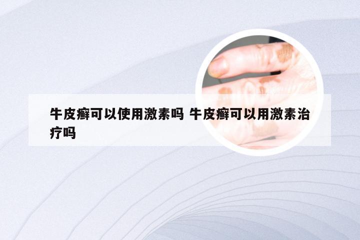 牛皮癣可以使用激素吗 牛皮癣可以用激素治疗吗