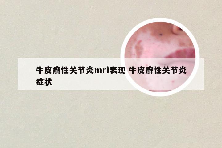 牛皮癣性关节炎mri表现 牛皮癣性关节炎症状