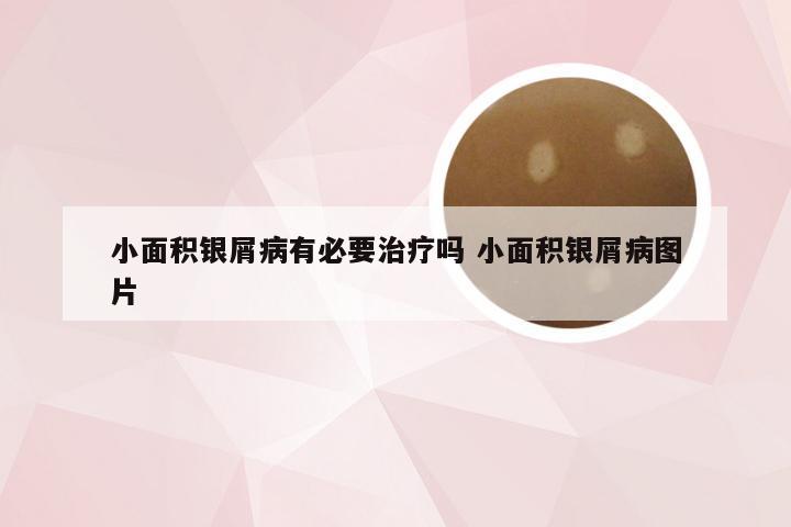 小面积银屑病有必要治疗吗 小面积银屑病图片