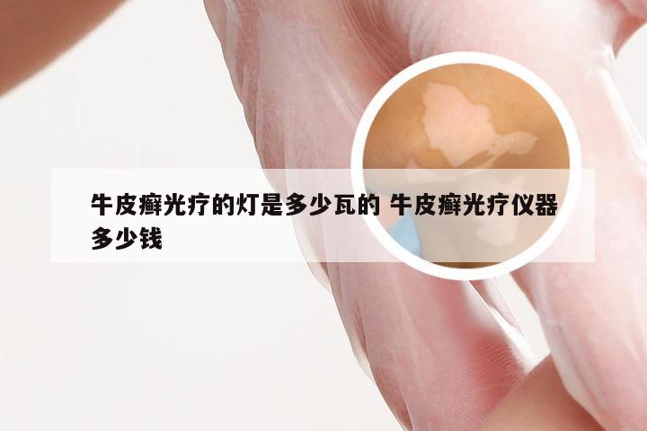牛皮癣光疗的灯是多少瓦的 牛皮癣光疗仪器多少钱