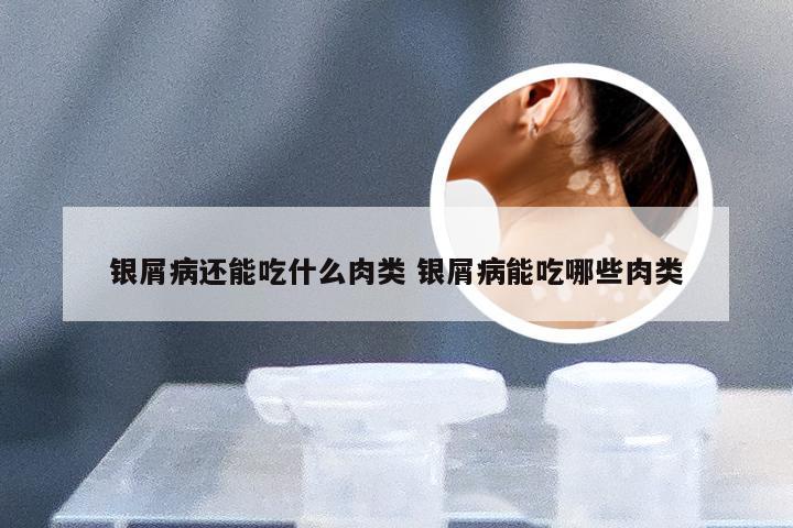 银屑病还能吃什么肉类 银屑病能吃哪些肉类