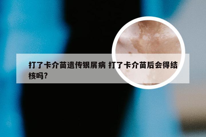 打了卡介苗遗传银屑病 打了卡介苗后会得结核吗?