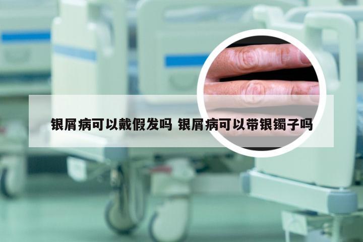 银屑病可以戴假发吗 银屑病可以带银镯子吗