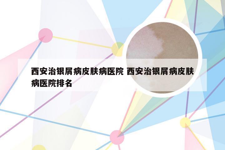 西安治银屑病皮肤病医院 西安治银屑病皮肤病医院排名