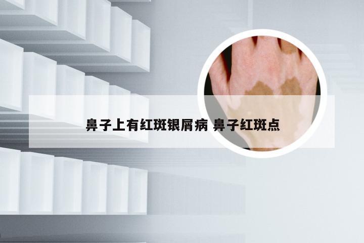 鼻子上有红斑银屑病 鼻子红斑点
