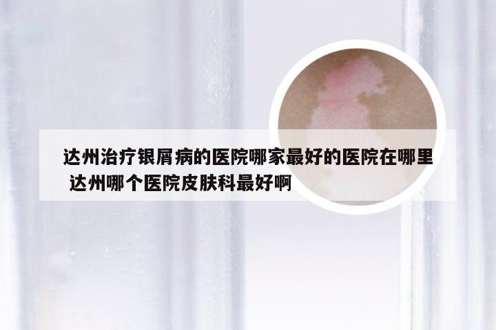 达州治疗银屑病的医院哪家最好的医院在哪里 达州哪个医院皮肤科最好啊
