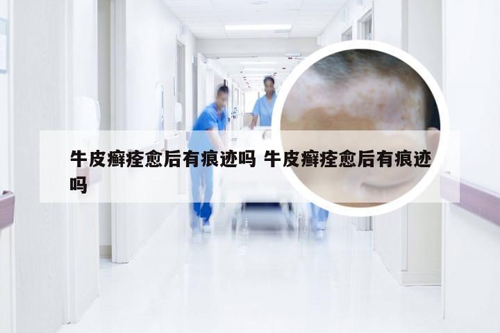 牛皮癣痊愈后有痕迹吗 牛皮癣痊愈后有痕迹吗