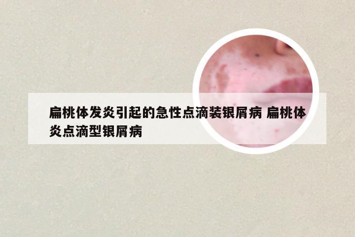 扁桃体发炎引起的急性点滴装银屑病 扁桃体炎点滴型银屑病