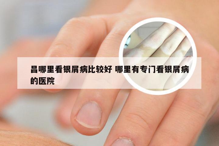 昌哪里看银屑病比较好 哪里有专门看银屑病的医院