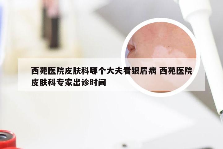 西苑医院皮肤科哪个大夫看银屑病 西苑医院皮肤科专家出诊时间