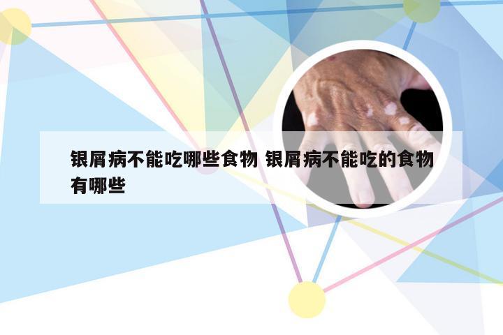 银屑病不能吃哪些食物 银屑病不能吃的食物有哪些