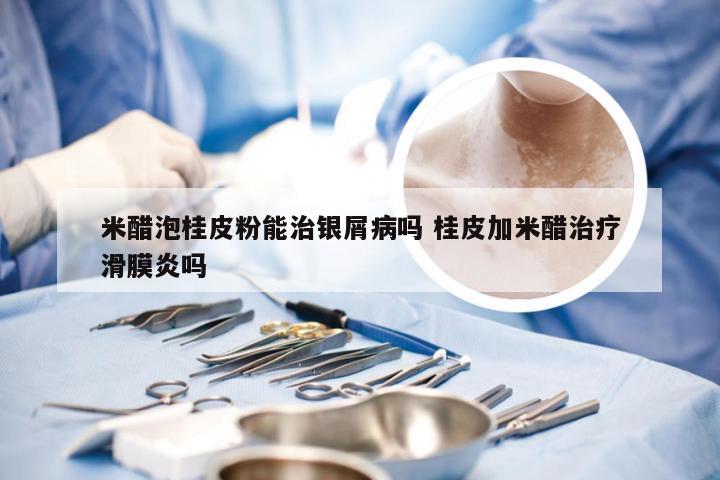 米醋泡桂皮粉能治银屑病吗 桂皮加米醋治疗滑膜炎吗