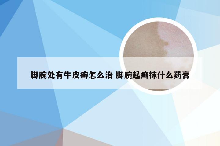 脚腕处有牛皮癣怎么治 脚腕起癣抹什么药膏