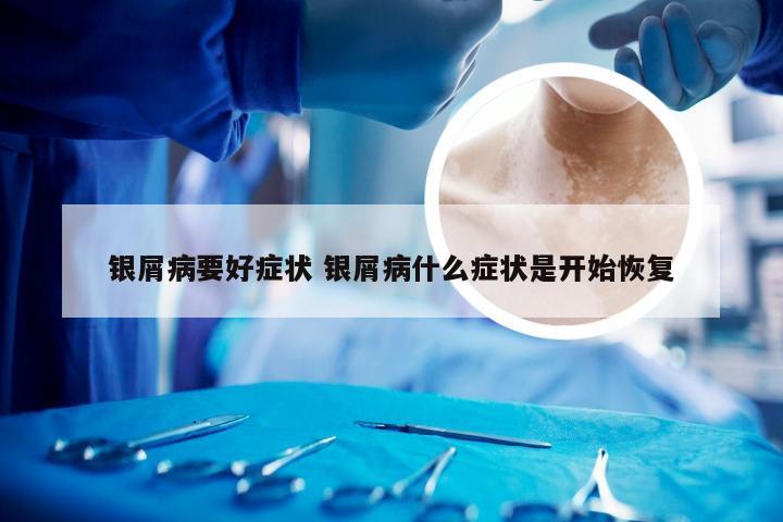 银屑病要好症状 银屑病什么症状是开始恢复
