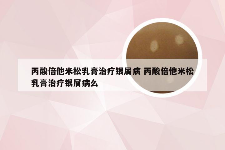 丙酸倍他米松乳膏治疗银屑病 丙酸倍他米松乳膏治疗银屑病么