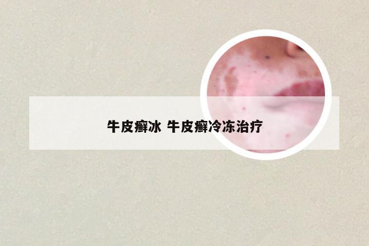 牛皮癣冰 牛皮癣冷冻治疗