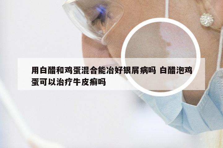 用白醋和鸡蛋混合能冶好银屑病吗 白醋泡鸡蛋可以治疗牛皮癣吗