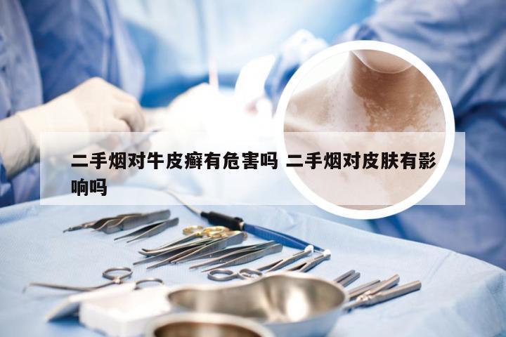 二手烟对牛皮癣有危害吗 二手烟对皮肤有影响吗