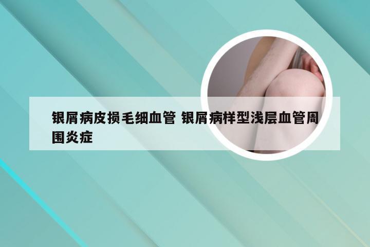 银屑病皮损毛细血管 银屑病样型浅层血管周围炎症
