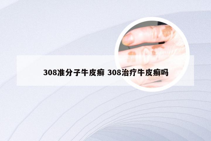 308准分子牛皮癣 308治疗牛皮癣吗