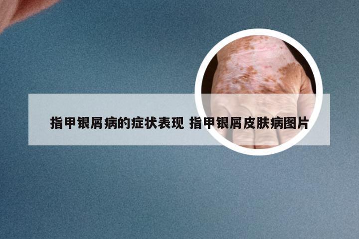指甲银屑病的症状表现 指甲银屑皮肤病图片