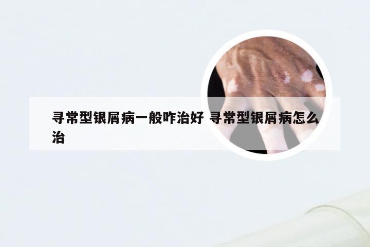 寻常型银屑病一般咋治好 寻常型银屑病怎么治
