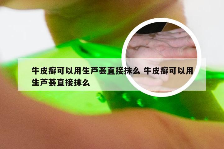 牛皮癣可以用生芦荟直接抹么 牛皮癣可以用生芦荟直接抹么