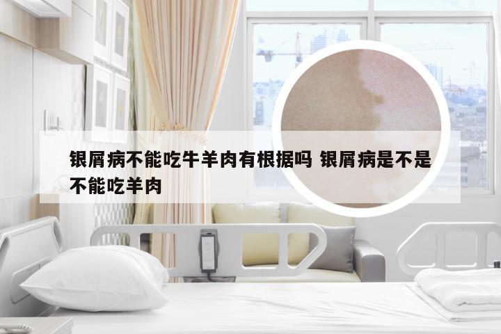 银屑病不能吃牛羊肉有根据吗 银屑病是不是不能吃羊肉