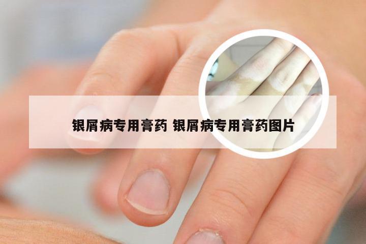 银屑病专用膏药 银屑病专用膏药图片