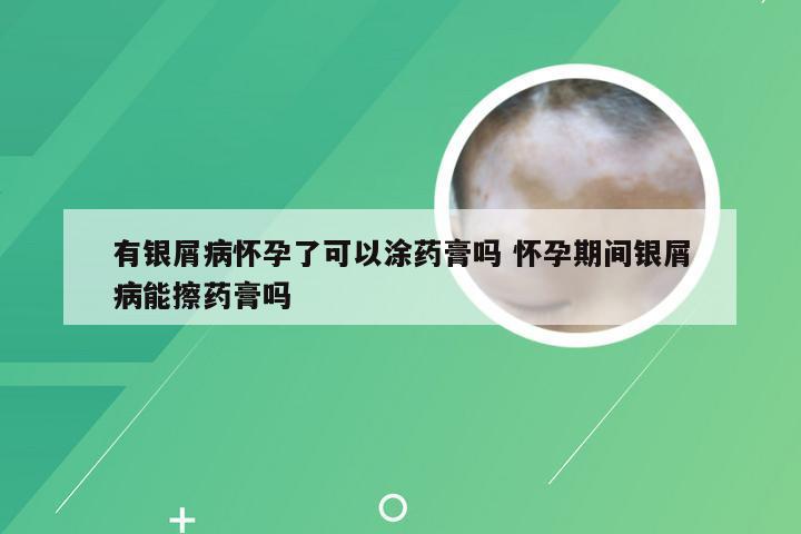 有银屑病怀孕了可以涂药膏吗 怀孕期间银屑病能擦药膏吗