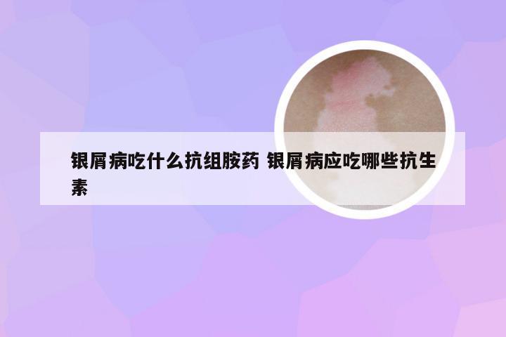 银屑病吃什么抗组胺药 银屑病应吃哪些抗生素