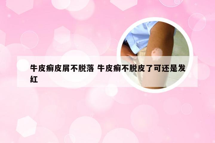 牛皮癣皮屑不脱落 牛皮癣不脱皮了可还是发红