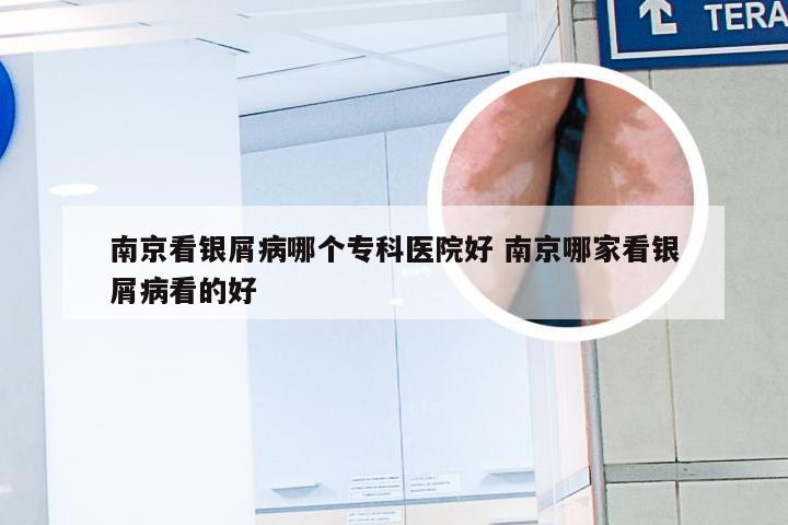 南京看银屑病哪个专科医院好 南京哪家看银屑病看的好