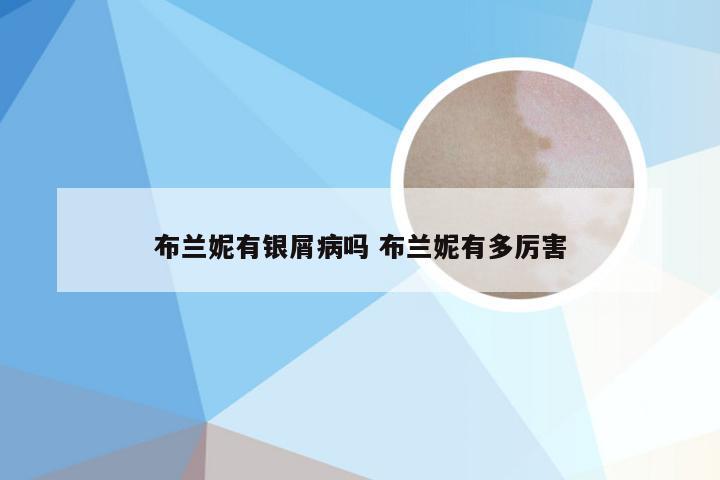 布兰妮有银屑病吗 布兰妮有多厉害